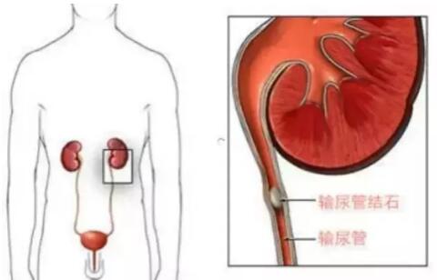 輸尿管結(jié)石，到底能不能保守治療？